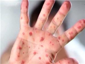 شیوع سرخک در آمریکا به بالاترین سطح در 25 سال اخیر رسید