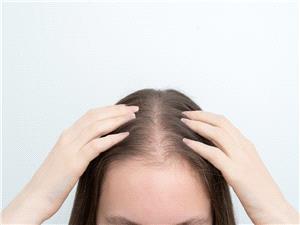 ابتکار کوری جدید یکبح تساقط الشعر بنسبه 92%