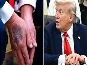 پزشک فیزیوتراپیست: شاید فقط 2 تا 4 سال از عمر ترامپ باقی مانده باشد