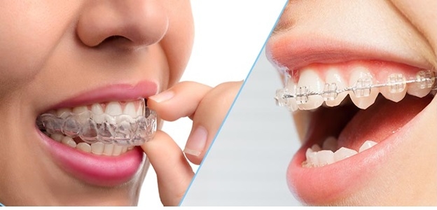 مقایسه بین ارتودنسی سرامیکی و ارتودنسی شفاف؛ کدام بهتر است؟