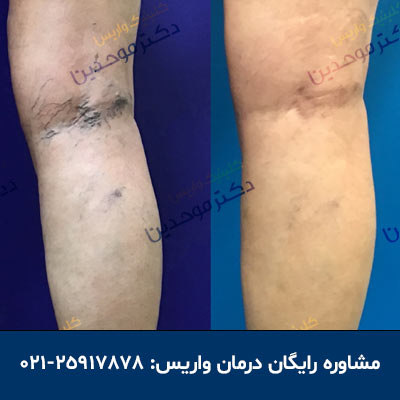 0 تا 100 کلینیک تخصصی درمان واریس
